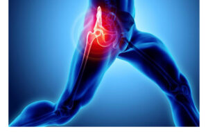 pubalgia negli sportivi